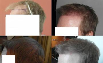 Hair transplantation surgery before and after pictures