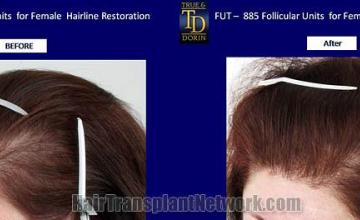 Hair transplantation surgery before and after pictures