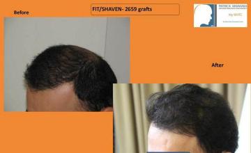 Hair transplantation surgery before and after images