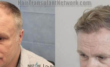 Hair transplantation surgery before and after images