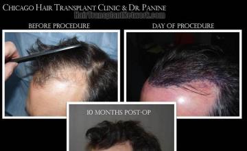 Hair transplantation surgery before and after photos