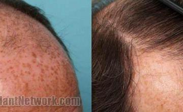 Right side before and after hair restoration photos