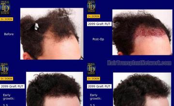 Hair transplantation surgery before and after photos