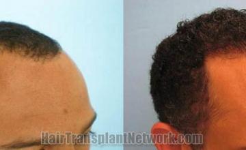 Hair restoration procedure before and after pictures