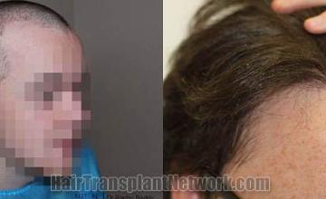 Hair transplantation surgery before and after images