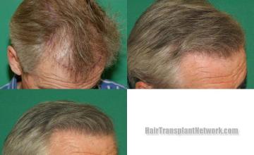 Hair transplantation surgery before and after photos