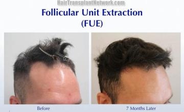 Hair restoration procedure before and after results