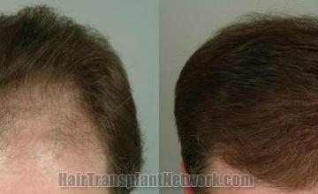 Top view before and after hair restoration photos