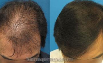 Top view before and after hair restoration results