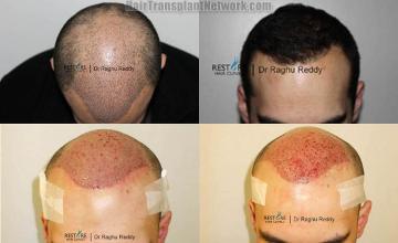 Hair restoration procedure before and after results