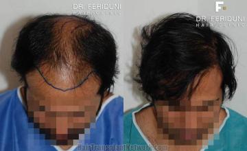 Hair restoration procedure before and after results