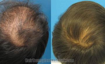 Hair transplantation surgery before and after images