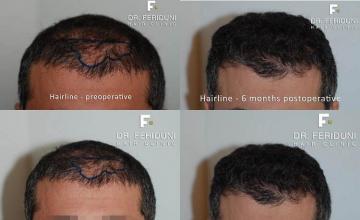 Hair restoration procedure before and after results