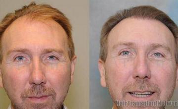 Front view - Before and after hair transplant photos