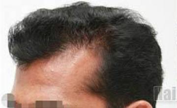 Hair restoration patient  before and result photographs