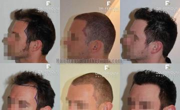 Hair transplantation surgery before and after photos