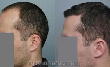 Hair restoration procedure before and after results