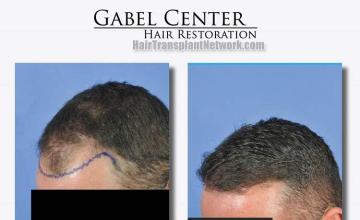 Hair restoration surgery before and after photos