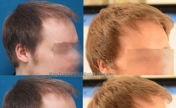 Hair transplantation surgery before and after images