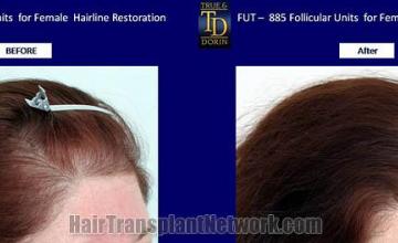 Hair transplantation surgery before and after images