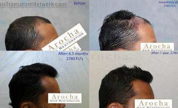 Hair transplantation surgery before and after images