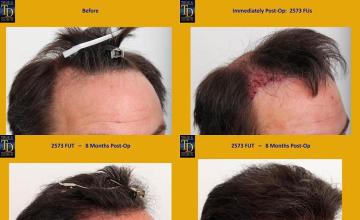 Hair transplantation surgery before and after images