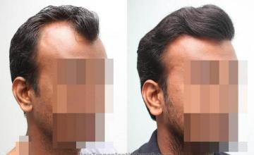 Hair transplantation surgery before and after images