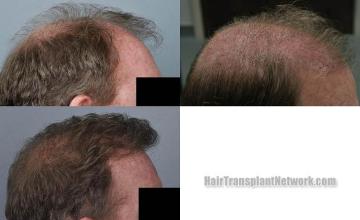 Hair transplantation surgery before and after images