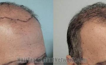 Hair transplantation surgery before and after photos