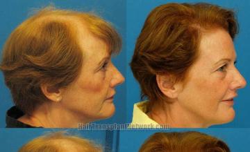 Hair transplantation surgery before and after pictures