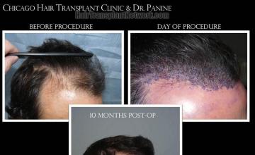 Hair restoration procedure before and after results