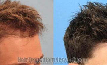 Hair transplantation surgery before and after images