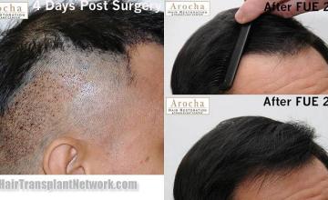 Hair transplantation surgery before and after images