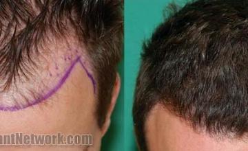 Top view before and after hair restoration results