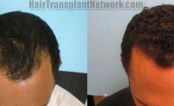 Hair transplantation surgery before and after images