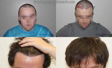 Hair transplantation surgery before and after photos