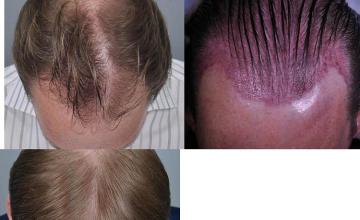 Hair transplantation surgery before and after images