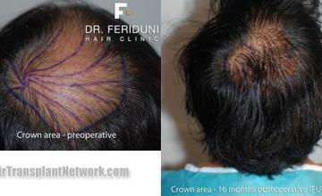 Hair transplantation surgery before and after pictures