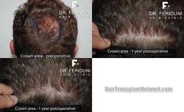 Hair transplantation surgery before and after pictures