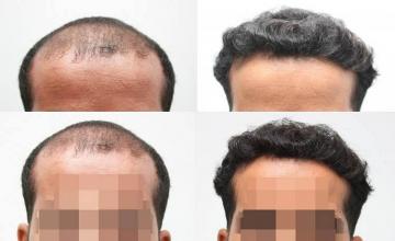 Hair restoration procedure before and after pictures