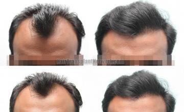 Hair restoration procedure before and after results