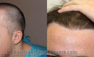 Hair transplantation surgery before and after pictures