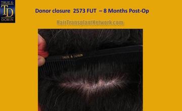 Hair restoration surgery before and after photos