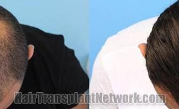 Hair transplantation surgery before and after photos