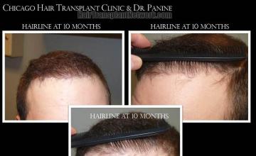 air transplant surgery hairline closeups