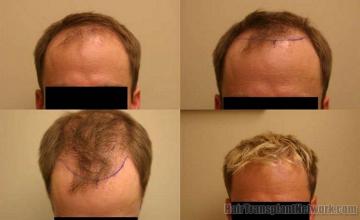 Hair replacement surgery patient before and after results