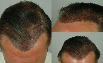 Surgical hair transplantation result photographs