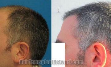 Hair restoration procedure results