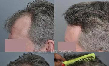 Hair restoration procedure before and after pictures