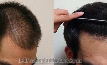 Before and after surgical hair restoration images